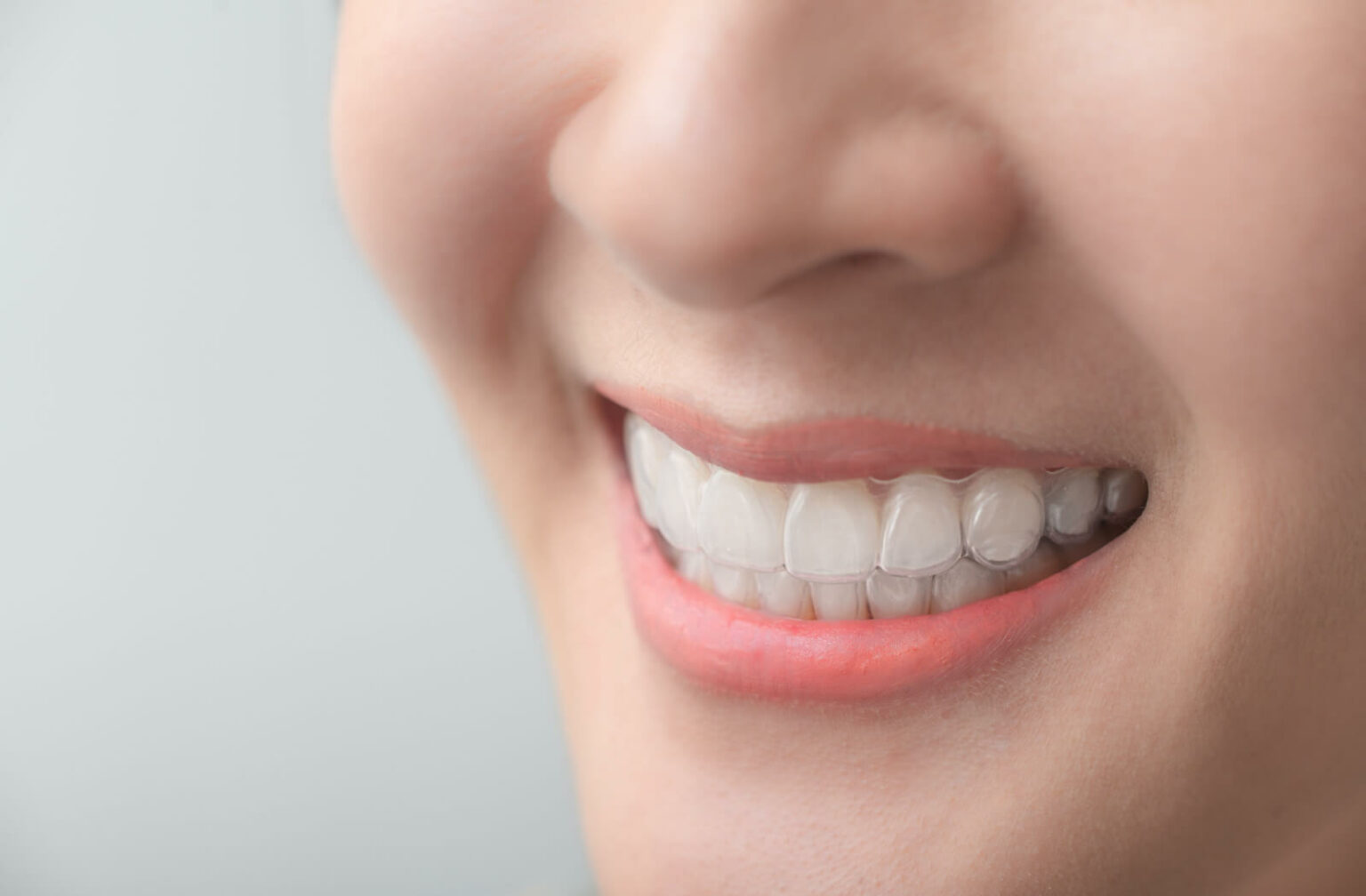 A close-up smile wearing clear Invisalign aligners