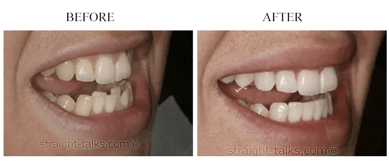 Inman Aligner results — before and after