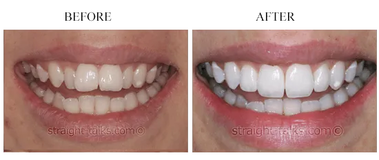 Smile transformation 10 — before and after