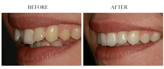 Smile transformation 11 — before and after
