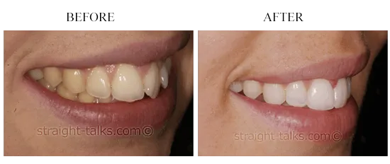 Smile transformation 12 — before and after