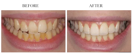 Smile transformation 13 — before and after