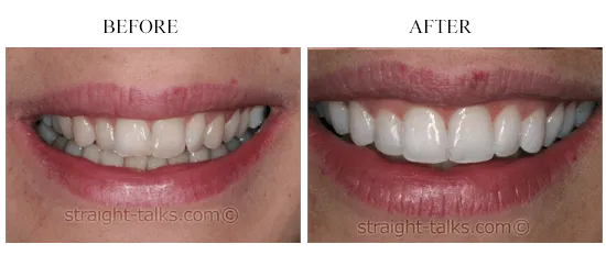 Smile transformation 2 — before and after