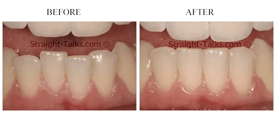 Smile transformation 3 — before and after