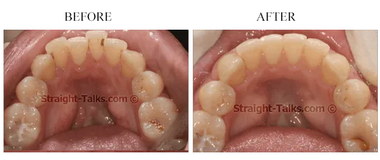 Smile transformation 4 — before and after
