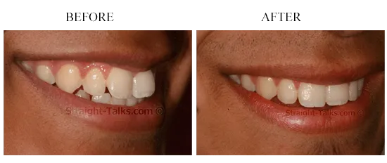 Smile transformation 5 — before and after