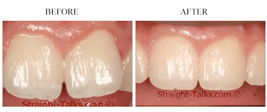 Smile transformation 6 — before and after