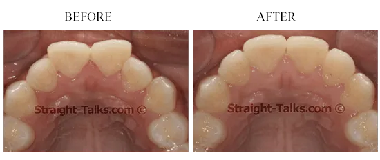 Smile transformation 7 — before and after