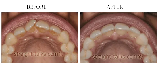 Smile transformation 8 — before and after