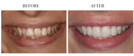 Smile transformation 9 — before and after