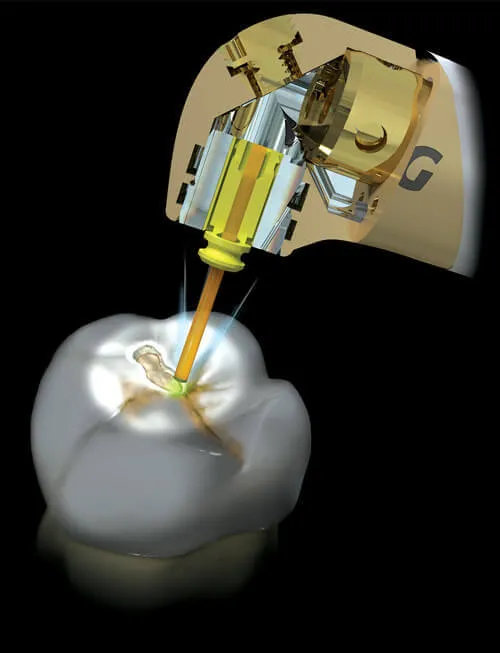 Waterlase Dentistry Tarzana CA